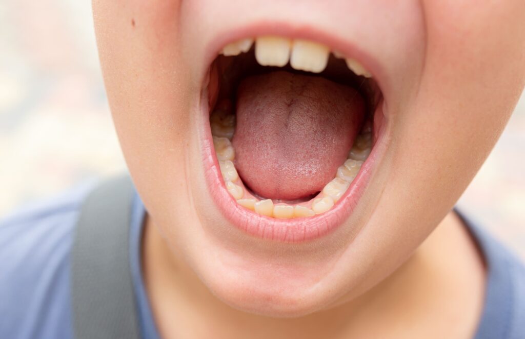 子供の歯並びが悪くなる8つの原因とは？